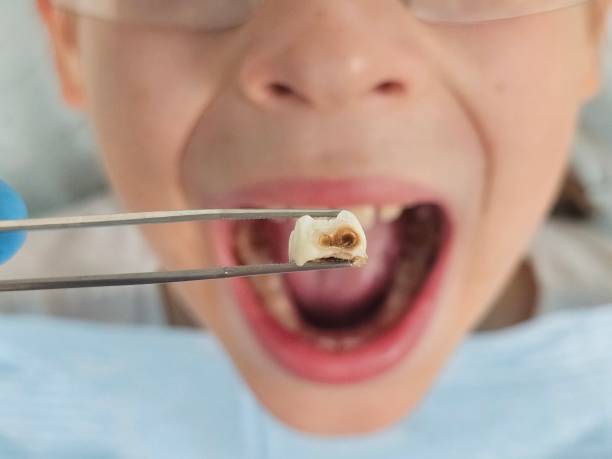 Best Emergency Treatment for Dental Infections or Abscesses in Ferris, TX